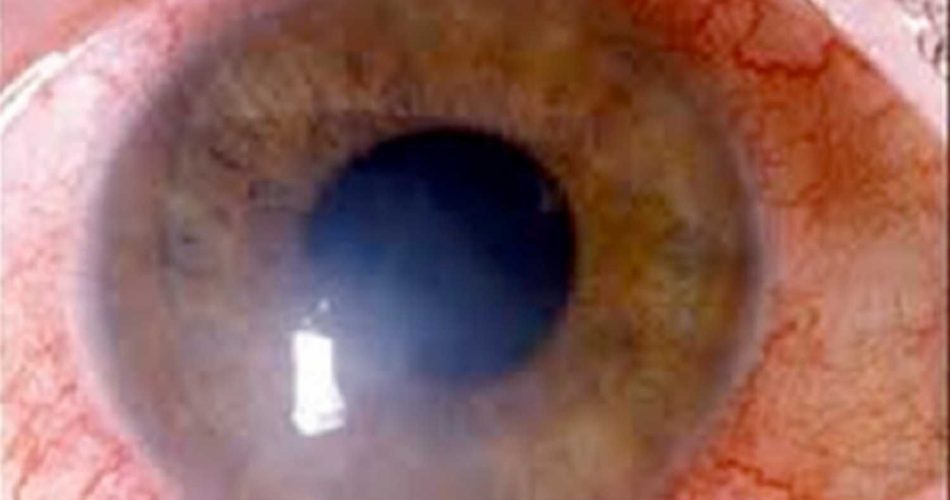 "Emerging Concerns: The Alarming Link Between Contact Lens Use and Pediatric Keratitis"
